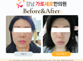정안침, 산삼라인샷, HIFU 초음파 리프팅, 탄력 매선