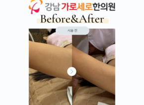 HIFU 초음파 리프팅
