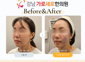 채움매선,리프팅매선, 탄력매선