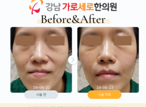 콜라겐부스터