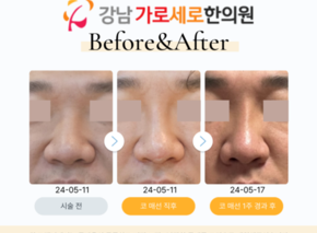 코 매선