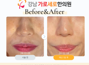 얼굴매선(팔자주름)