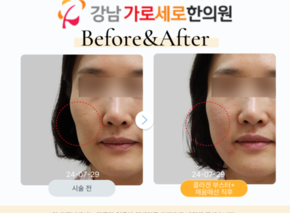 콜라겐부스터+채움매선