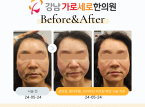 얼굴매선(상안검,팔자주름,브이라인)