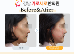 콜라겐부스터+채움매선