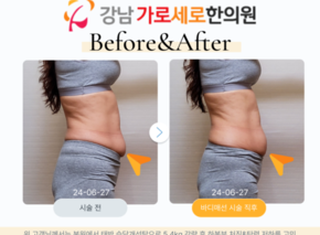 바디매선(하복부쳐짐,탄력저하)