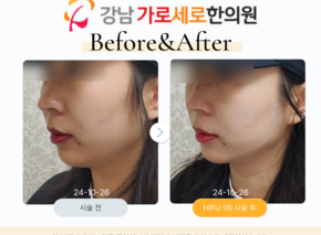 HIFU 초음파 리프팅