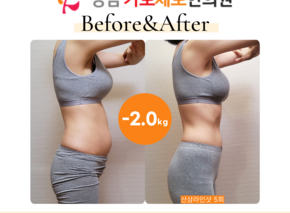  [-2kg] 복부 산삼라인샷 5회 전후사진
