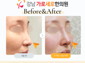 세코로 코실리프팅 코매선
