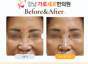 탄력매선