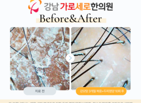 [40대 여성/탈모치료]  강모탕,두피영양