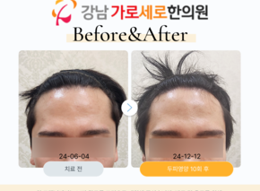[30대 남성/탈모치료] 두피영양