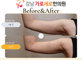 [30대 여성] 팔뚝 바디매선 2회