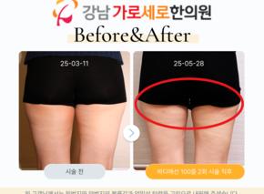 [30대 여성] 허벅지 바디매선 2회