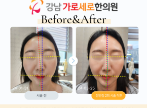 정안침 2회