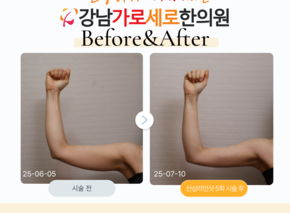 [30대 여성] 팔뚝 산삼라인샷 5회