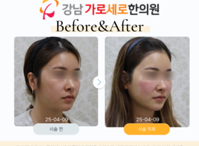 HIFU(초음파리프팅) 400샷 1회,산삼라인샷 5cc