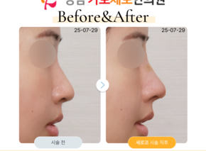 세로코 코실리프팅 코매선