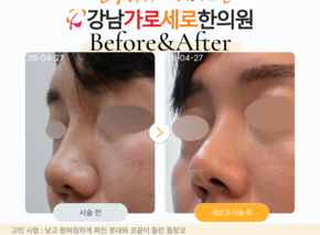 세로코 코실리프팅 코매선