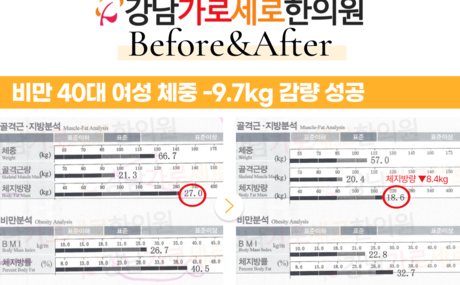  [-9.7kg 감량] 비만 40대 여성 녹용 습담개선탕 복용 전후 인바디