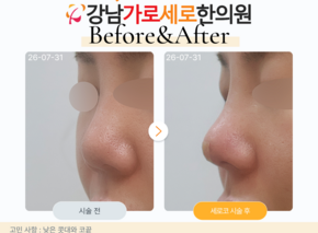 세로코 코실리프팅 코매선