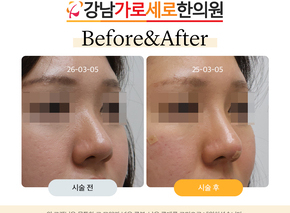 세로코 코실리프팅 코매선