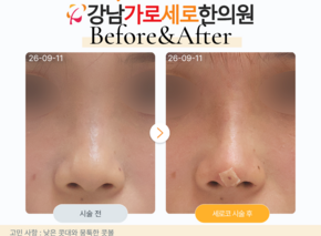 세로코 코실리프팅 코매선