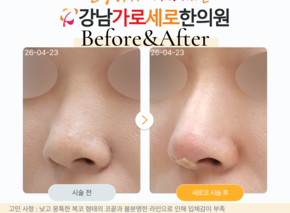 세로코 코실리프팅 코매선
