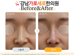 세로코 코실리프팅 코매선