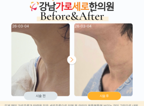 목주름 탄력매선/엑소좀 스킨부스터 1회