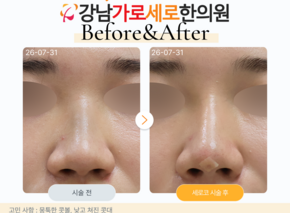 세로코 코실리프팅 코매선