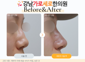 세로코 코실리프팅 코매선