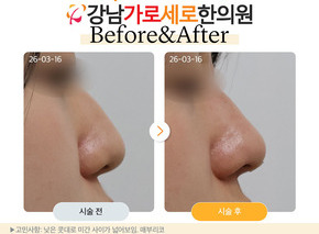 세로코 코실리프팅 코매선