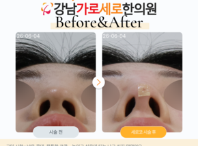 세로코 코실리프팅 코매선