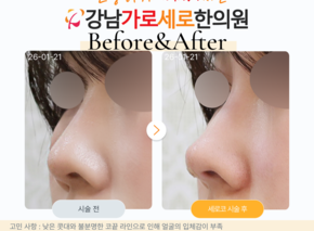  세로코 직반버선코 코실리프팅 코매선