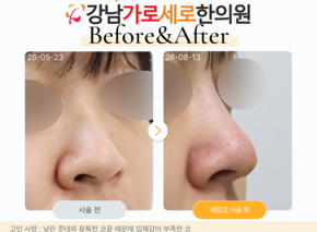 세로코 코실리프팅 코매선