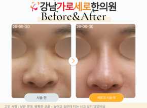 세로코 코실리프팅 코매선