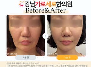 중안부 심부볼 팔자주름 리프팅매선 콜라겐부스터