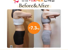 [-7.3kg] 습담개선탕 복용 전후사진